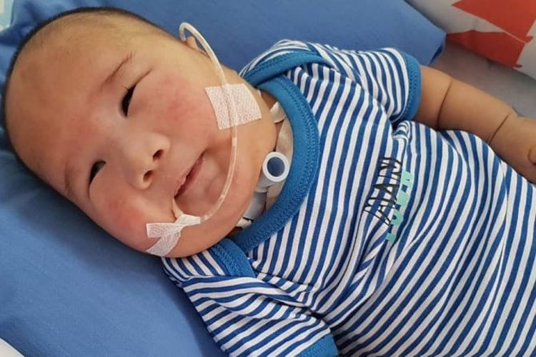 Sindrom Patau (Trisomi 13)